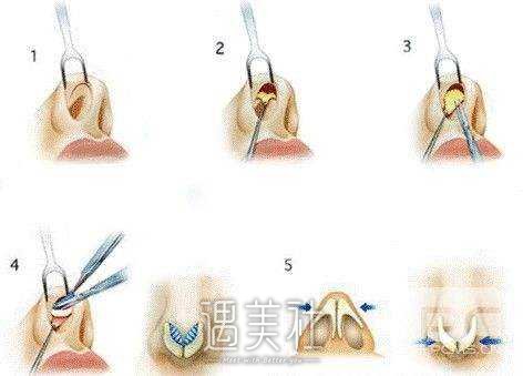 硅橡胶隆鼻要多少钱|硅橡胶隆鼻价格贵吗？