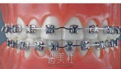 牙齿矫正后悔一辈子的说法从何而来，有啥危害？ width=