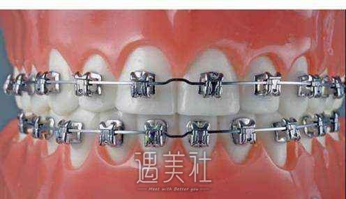 牙齿矫正后悔一辈子