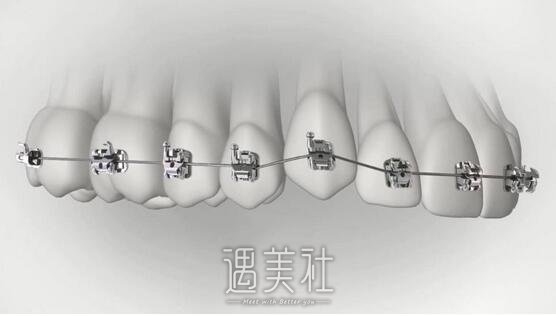 牙齿矫正后悔一辈子