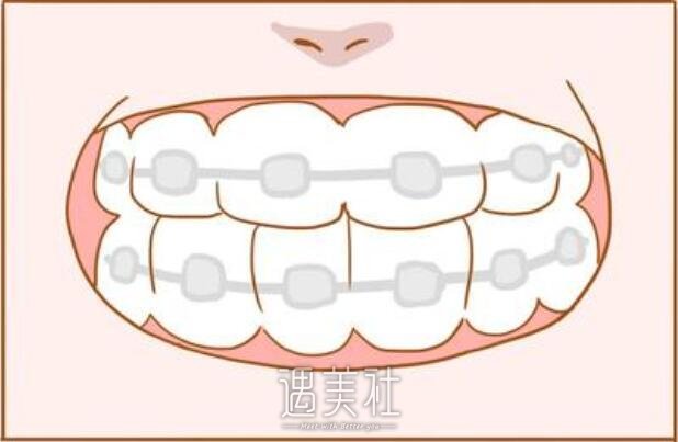 牙齿矫正后悔一辈子