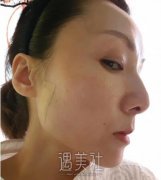 侯典举内窥镜除皱案例分享|瞬间年轻数十岁! width=