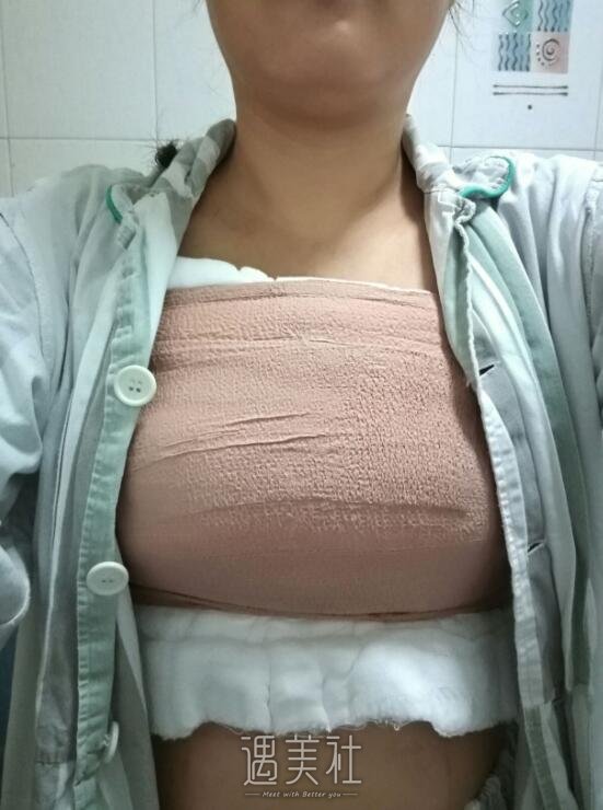 栗勇缩胸手术靠谱吗?内附案例恢复对比