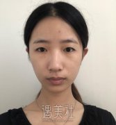 马显杰双眼皮案例分享|真想马上拥有! width=