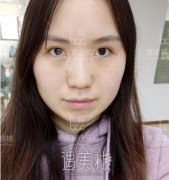 【土气红脸蛋变洋气女神】关于红血丝，重庆联合丽格一招搞定！ width=