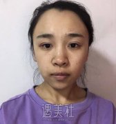 运城薛大夫双眼皮整形案例分享|15天果图一览~ width=