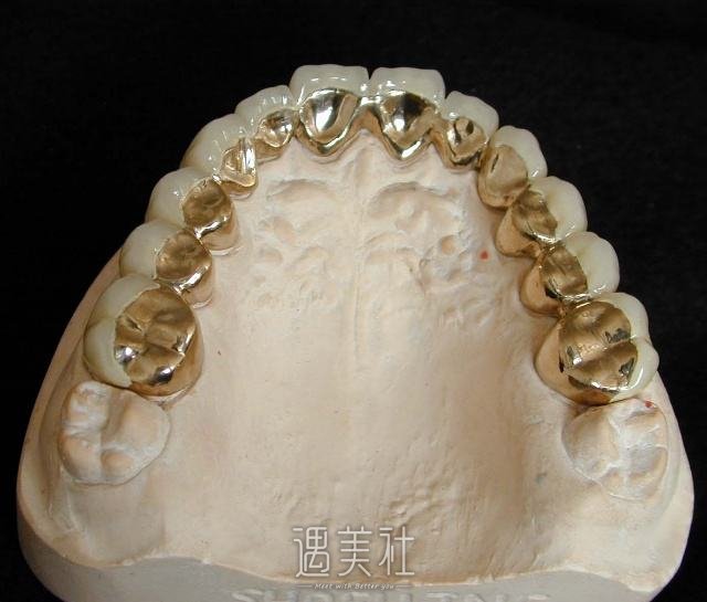 镍铬合金烤瓷牙的优缺点分别有哪些?