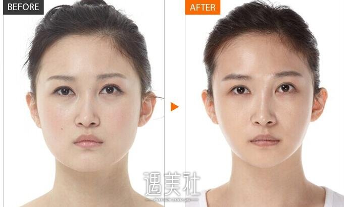 垫下巴前后对比图|男女都可以隆下巴
