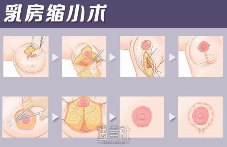 缩胸手术的后遗症图片,缩胸有什么危害呢?
