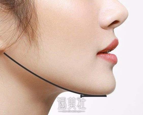 双下巴抽脂恢复期有多久？ width=