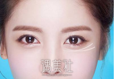 上海割双眼皮好的医院有哪些？ width=