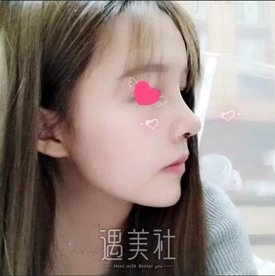 谢双灵鼻部手术案例|变化惊呆了小伙伴! width=