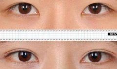 双眼皮做失败怎么修复？