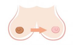 乳晕镭射漂红多久才自然？多久恢复？ width=