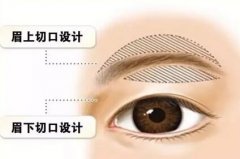眉部整形美容手术价格多少钱 width=