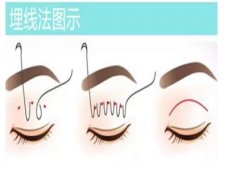 高分子埋线双眼皮多少钱?