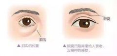 自体脂肪填充眼窝的果是长久的吗?