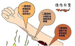 烫伤疤痕修复多少钱? width=