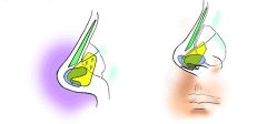 鼻小柱延长三种手术方法改良鼻畸形 width=