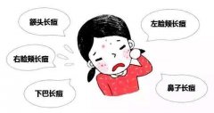 激光祛青春痘改良肌肤无可挑剔 width=