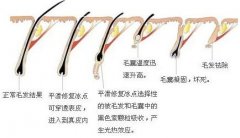 光子脱毛调节后千万不能疏于护理 width=