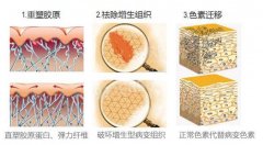 激光去疤痕不反弹促进皮肤再生 width=