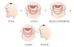 假体丰下巴出现哪些情况需要将假体取出 width=