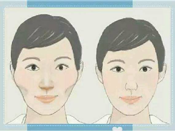 颧骨整形手术不适合那些求美者