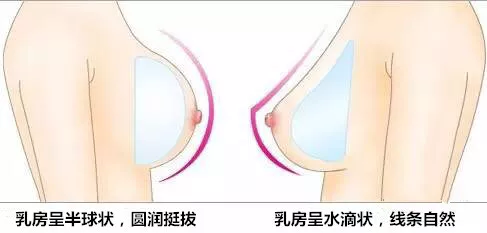 水滴型假体隆胸一个月果照片——南京艺星真实案例~