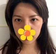 伊美尔cfs芭比大眼术+纳米脂肪混血脸2个月的果哦~ width=