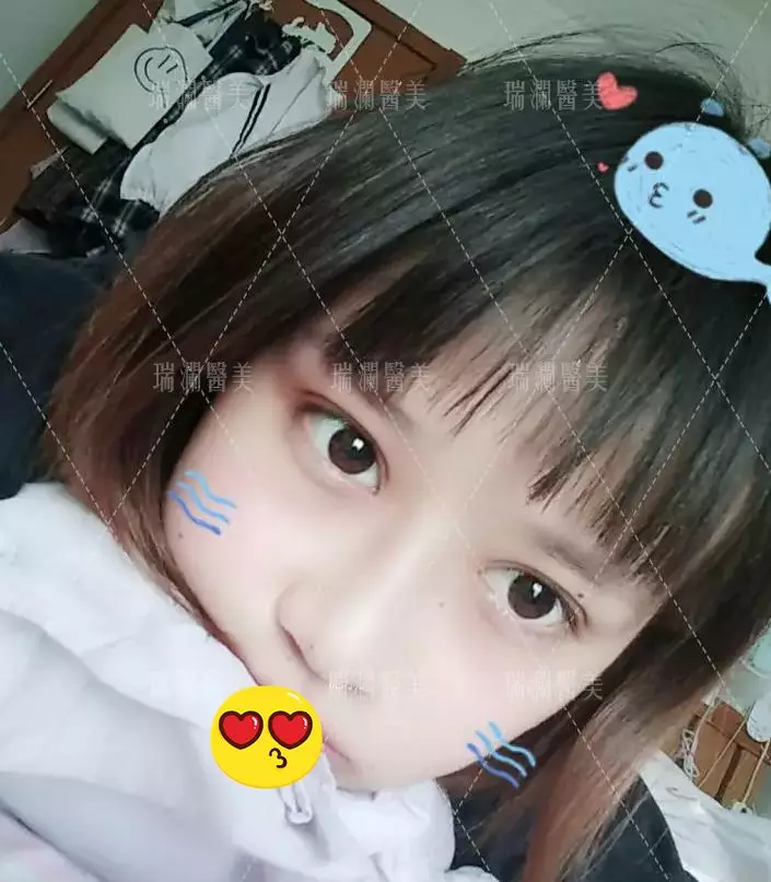 瑞澜芭比仿生俏鼻术案例罕见曝光，还不来围观？！