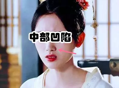 自体肋软骨隆鼻有后遗症吗？这则案例告诉你~