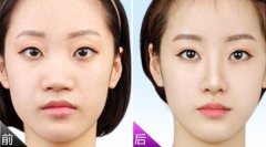 北京鼻翼整形是多少钱? width=