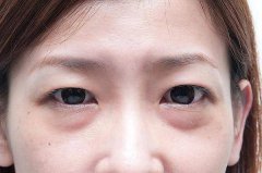 眼袋的分类以及眼袋整复术手术操作 width=