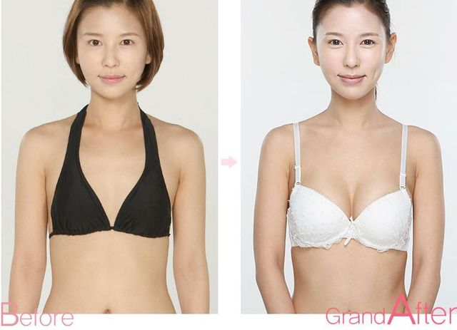 因隆胸而变自信的上海美女