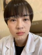 自体脂肪填充苹果肌好还是用玻尿酸更好？我来给你们好好上一课~ width=