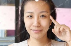 切开法双眼皮多少钱？果咋样？不要急，慢慢看完这篇文章吧！ width=