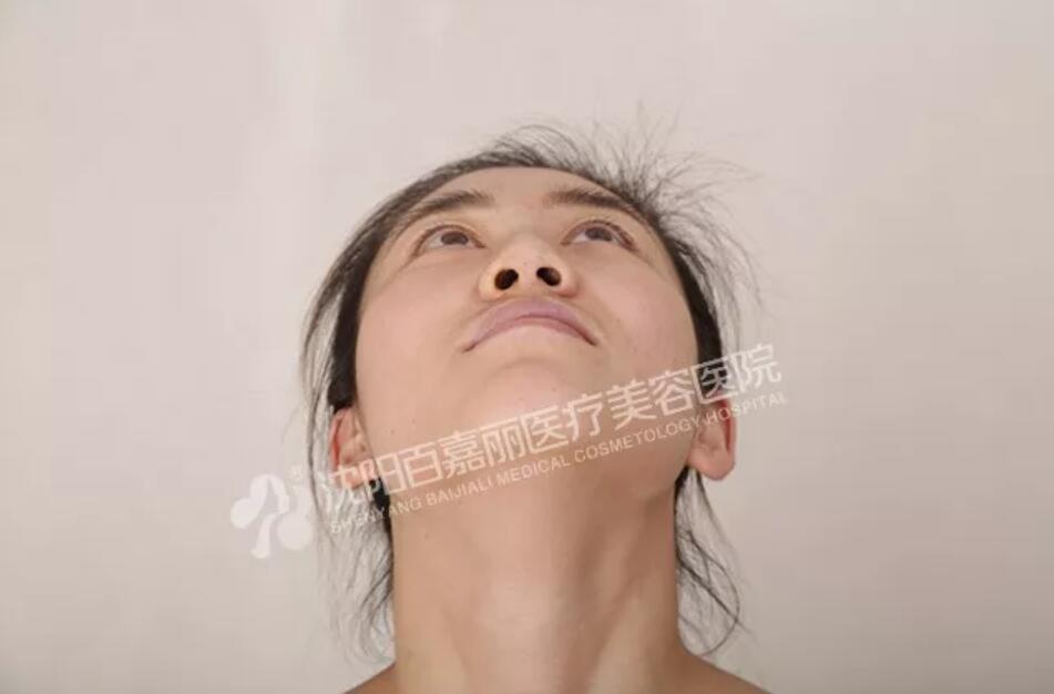 【鼻部手术整形价格要how much？下面这条真实案例tells you！】