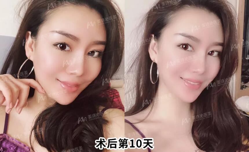 惊艳！从阿姨脸进阶到少女脸？这位网红悄悄动了这个部位！