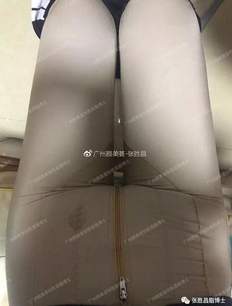 【大腿环吸案例】“从59cm到52cm，果较为满意，还想找你抽背”