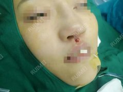 美女隆鼻期待变美，却坏疽性溃疡险些毁容！ width=