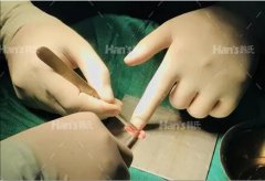 耳软骨取出后耳朵会塌？一起聊聊耳软骨隆鼻的那些事儿 width=