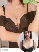 妙桃假体隆胸价格多少钱？下面的案例里面有答案吗？去看看！ width=