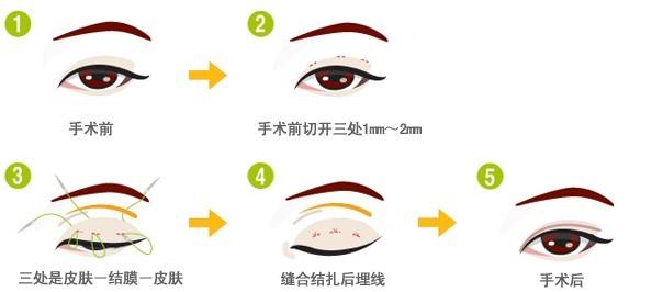 2019******版韩式三点双眼皮的价格?