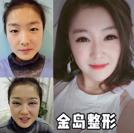 【做了双眼皮后，形象分大涨让我如愿当上了空姐】