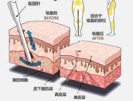 合肥华美腹部抽脂多少钱?