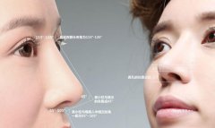 修复鼻缺损案例分享，感谢我的医生 width=