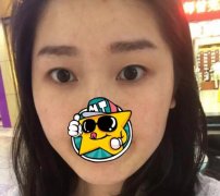 全切双眼皮45天经验，一定要选择适合自己的双眼皮类型 width=