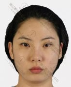 【双眼皮修复+眼型矫正】术后两个半月——来自乌鲁木齐医瑞~ width=