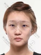 芭比翘睫眼部手术整形日记一则·来自医瑞医美的网红双眼皮项目！ width=